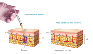 Renuva-Remodeling-Hilinski